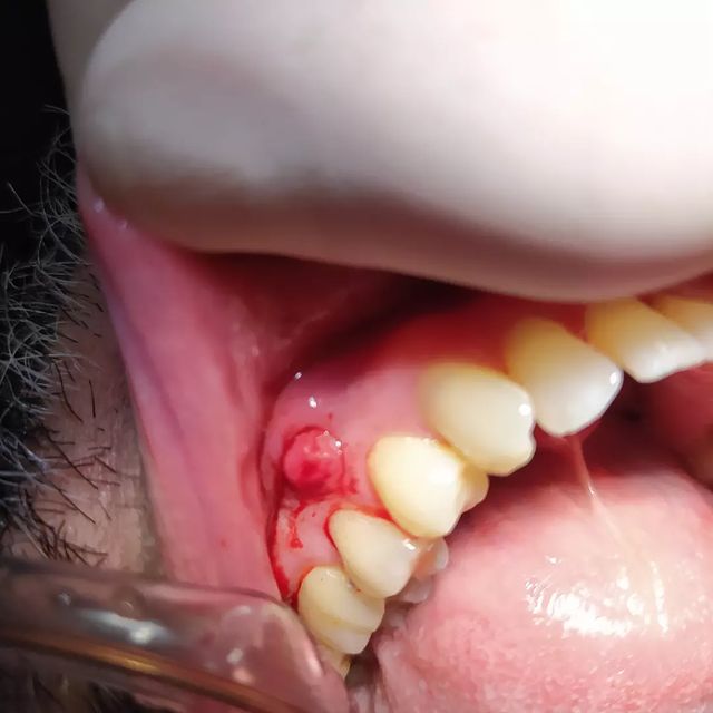 Instagram post: Caso que chegou na clínica com presença de dor. Paciente reclamava de "bolinha" na região de Pré-Molares que tinha gosto ruim e doia ao t...
